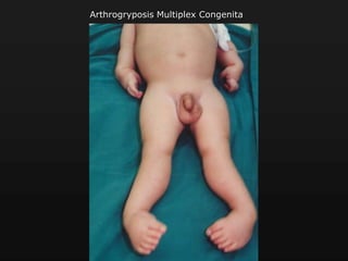 Arthrogryposis Multiplex Congenita
 