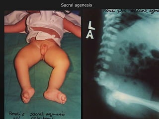 Sacral agenesis
 