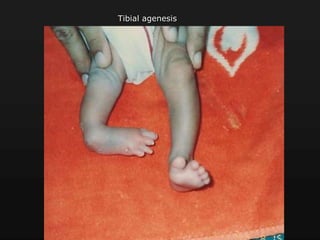 Tibial agenesis
 