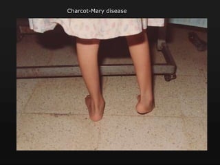 Charcot-Mary disease
 