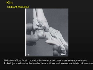 Abduction of fore foot in pronation the cavus becomes more severe, calcaneus
locked (jammed) under the head of talus; mid foot and forefoot are twisted  eversion
Kite
Clubfoot correction
 