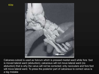 Calcaneo-cuboid is used as fulcrum which is pressed medial ward while fore foot
is moved lateral ward (abduction); calcaneus will not move lateral ward (no
abduction) that is why the varus will not be corrected; only naviculare and fore foot
will move lateral ward. To press the posterior part of calcaneus to correct varus is
a big mistake
Kite
 