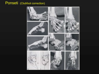 Ponseti (Clubfoot correction)
 