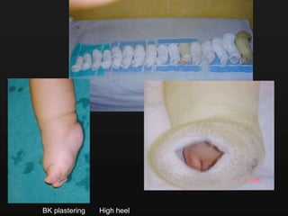 BK plastering High heel
 