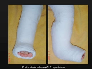 Post posterior release ATL & capsulotomy
 