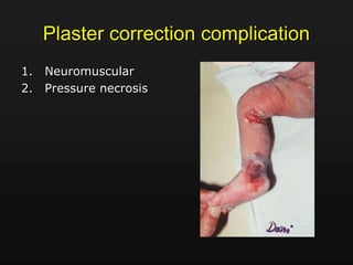 Plaster correction complication
1. Neuromuscular
2. Pressure necrosis
 