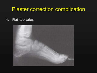 Plaster correction complication
4. Flat top talus
 