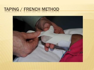 Clubfoot prof g s patnaik | PPTX