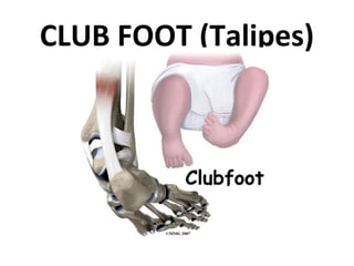 CLUB FOOT (Talipes)
 