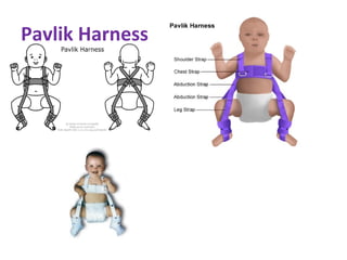 Pavlik Harness
 