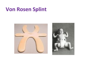 Von Rosen Splint
 