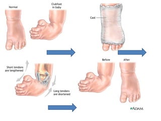 Club Foot 1 Club Foot 1