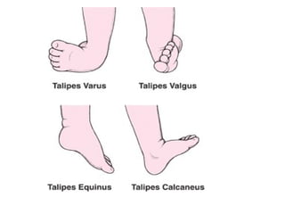 Club Foot 1 Club Foot 1