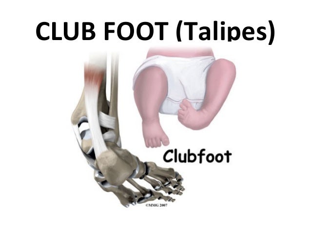 Club Foot 1 Club Foot 1