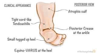 CLUB FOOT 1.pptx