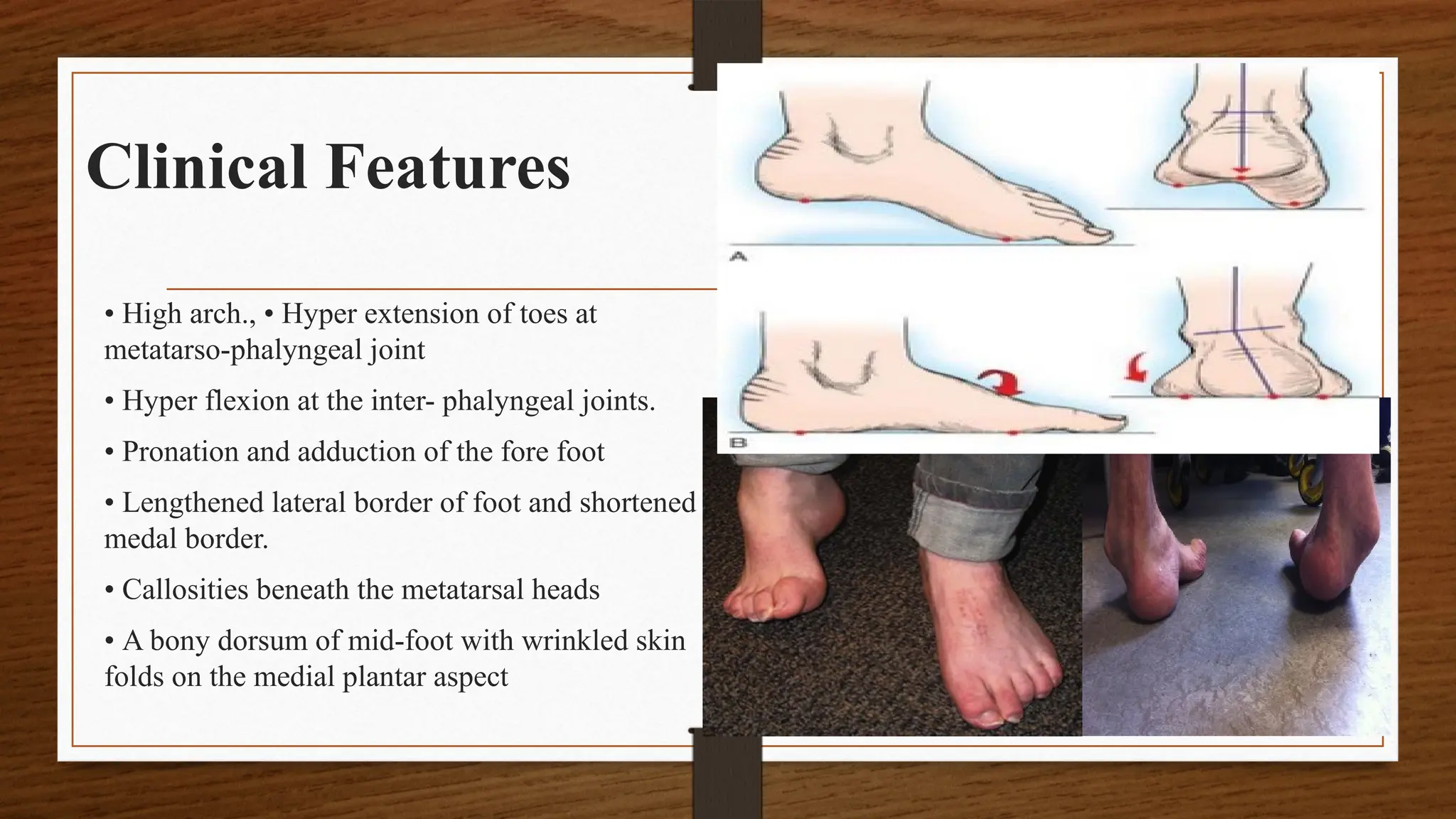 Fore Toe CLUB FOOT (2).pptxnnnnnnnnnnnnnnnnnnnnnnnn | PPTX