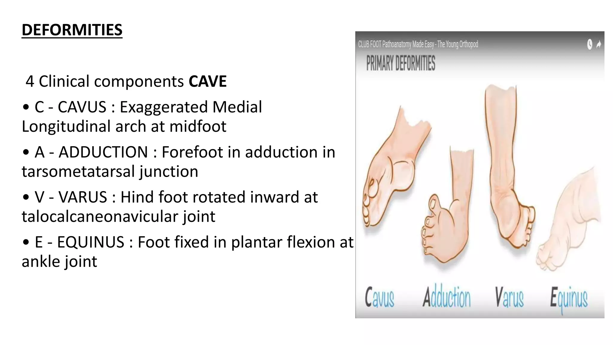 Ctev Types CTEV / Club foot by Dr Baijnath Agrahari | PPT