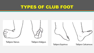 Congenital Club Foot Medical Information