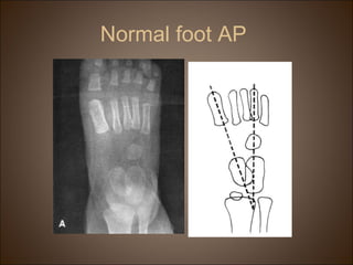 Normal foot AP