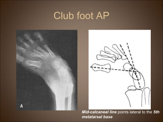 Club foot AP
Mid-calcaneal line points lateral to the 5th
metatarsal base