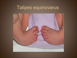 Talipes equinovarus