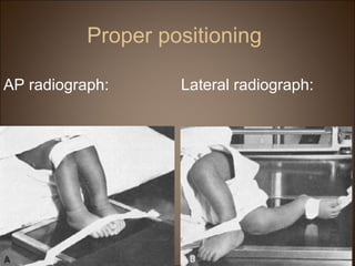Proper positioning
AP radiograph:
Lateral radiograph: