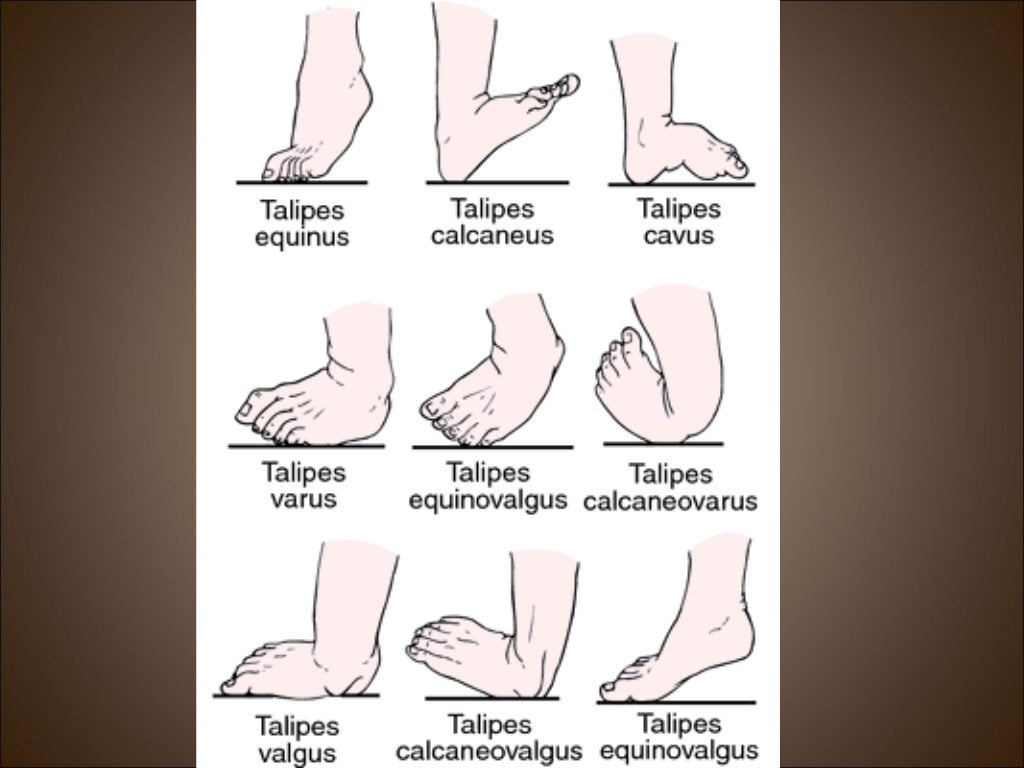 Club foot deformity