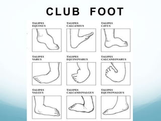 Clubfoot | PPTX