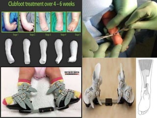 clubfoot ppt.pptx