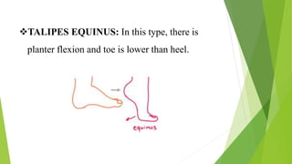 club foot ppt.pptx