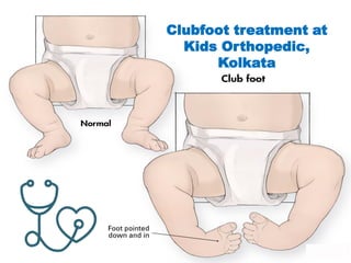 Clubfoot treatment at
Kids Orthopedic,
Kolkata
 