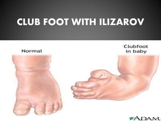 CLUB FOOT WITH ILIZAROV
 
