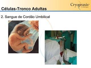 Células-Tronco   Adultas 2. Sangue de Cordão Umbilical 