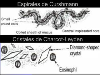 Espirales de Curshmann




Cristales de Charcot-Leyden
 