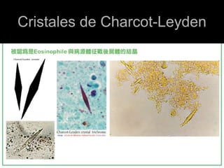 Cristales de Charcot-Leyden
 