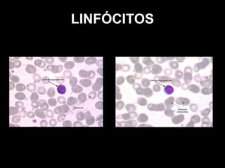 LINFÓCITOS
 