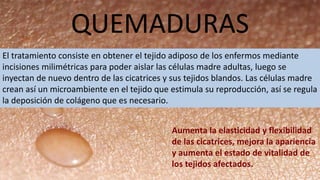 QUEMADURAS
El tratamiento consiste en obtener el tejido adiposo de los enfermos mediante
incisiones milimétricas para poder aislar las células madre adultas, luego se
inyectan de nuevo dentro de las cicatrices y sus tejidos blandos. Las células madre
crean así un microambiente en el tejido que estimula su reproducción, así se regula
la deposición de colágeno que es necesario.
Aumenta la elasticidad y flexibilidad
de las cicatrices, mejora la apariencia
y aumenta el estado de vitalidad de
los tejidos afectados.
 