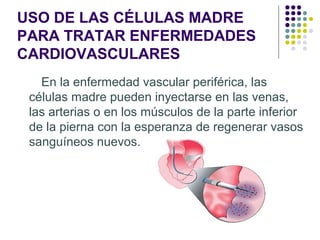 USO DE LAS CÉLULAS MADRE
PARA TRATAR ENFERMEDADES
CARDIOVASCULARES
En la enfermedad vascular periférica, las
células madre pueden inyectarse en las venas,
las arterias o en los músculos de la parte inferior
de la pierna con la esperanza de regenerar vasos
sanguíneos nuevos.

 