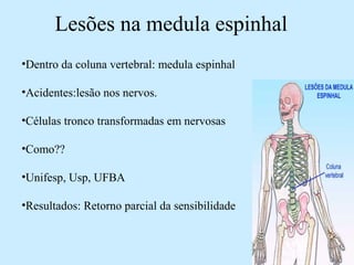 Lesões na medula espinhal
•Dentro da coluna vertebral: medula espinhal
•Acidentes:lesão nos nervos.
•Células tronco transformadas em nervosas
•Como??
•Unifesp, Usp, UFBA
•Resultados: Retorno parcial da sensibilidade
 