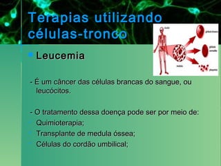 Terapias utilizando
células-tronco
   Leucemia

- É um câncer das células brancas do sangue, ou
  leucócitos. 

- O tratamento dessa doença pode ser por meio de:
 Quimioterapia;

 Transplante de medula óssea;

 Células do cordão umbilical;
 