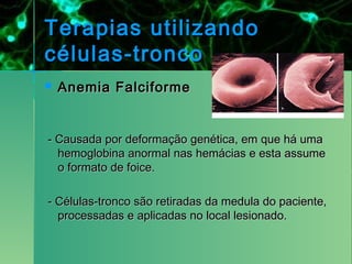 Terapias utilizando
células-tronco
   Anemia Falciforme


- Causada por deformação genética, em que há uma
  hemoglobina anormal nas hemácias e esta assume
  o formato de foice.

- Células-tronco são retiradas da medula do paciente,
  processadas e aplicadas no local lesionado.
 