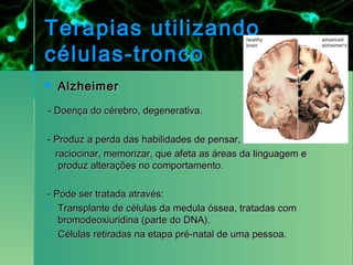 Terapias utilizando
células-tronco
   Alzheimer

- Doença do cérebro, degenerativa.

- Produz a perda das habilidades de pensar,
  raciocinar, memorizar, que afeta as áreas da linguagem e
   produz alterações no comportamento.

- Pode ser tratada através:
 Transplante de células da medula óssea, tratadas com
   bromodeoxiuridina (parte do DNA).
 Células retiradas na etapa pré-natal de uma pessoa.
 