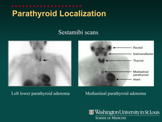 Parathyroid Localization Sestamibi scans Left lower parathyroid adenoma Mediastinal parathyroid adenoma 