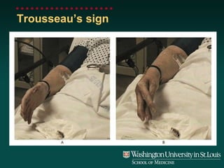 Trousseau’s sign 