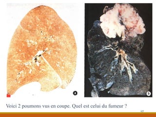 Voici 2 poumons vus en coupe. Quel est celui du fumeur ?
17
 