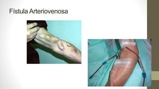 Fístula Arteriovenosa
 