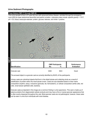 Urine Sediment Photographs

CMP-17

Case History CMP-17 through CMP-20
This urine sample is from a 37-year-old man with advanced kidney disease, admitted through the emergency
room (ER) for lower abdominal discomfort and painful urination. Laboratory data include: specific gravity = 1.017,
pH = 5.0; blood, leukocyte esterase, protein, glucose, ketones, and nitrite = positive.

CMP Participants
No.
%

Identification
Granular cast

4393

96.8

Performance
Evaluation
Good

The arrowed object is a granular cast as correctly identified by 96.8% of the participants.
Urinary casts are cylindrical objects that form in the distal tubules and collecting ducts as a result of
solidification of protein within the renal tubular lumen. Casts are sub-classified based on their matrix
composition (hyaline, waxy), inclusions (granules, fat, hemosiderin), or cellular composition (white cells, red
cells, renal tubular epithelial cells, bacteria).
Granular casts as depicted in this image are a common finding in urine specimens. This cast is made up of
plasma proteins from degenerated cellular products and may have a fine or coarse granular appearance that
is often evenly dispersed throughout the cast. Most granular casts are not pathological; however, these casts
can be seen in urine from individuals with renal disease.

63

 