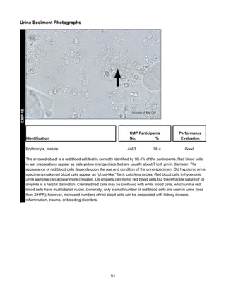 CMP-18

Urine Sediment Photographs

CMP Participants
No.
%

Identification
Erythrocyte, mature

4463

98.4

Performance
Evaluation
Good

The arrowed object is a red blood cell that is correctly identified by 98.4% of the participants. Red blood cells
in wet preparations appear as pale yellow-orange discs that are usually about 7 to 8 μm in diameter. The
appearance of red blood cells depends upon the age and condition of the urine specimen. Old hypotonic urine
specimens make red blood cells appear as “ghost-like,” faint, colorless circles. Red blood cells in hypertonic
urine samples can appear more crenated. Oil droplets can mimic red blood cells but the refractile nature of oil
droplets is a helpful distinction. Crenated red cells may be confused with white blood cells, which unlike red
blood cells have multilobated nuclei. Generally, only a small number of red blood cells are seen in urine (less
than 3/HPF); however, increased numbers of red blood cells can be associated with kidney disease,
inflammation, trauma, or bleeding disorders.

64

 