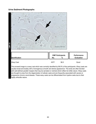 CMP-19

Urine Sediment Photographs

CMP Participants
Identification

Performance

No.

Evaluation

4377

Waxy Cast

%
96.5

Good

The arrowed image is a waxy cast which was correctly identified by 96.5% of the participants. Waxy casts are
usually broad and stubby with a homogenous smooth and dense appearance. The ends are often blunted
with well-defined parallel margins that may be serrated or notched which reflect its brittle nature. Waxy casts
are thought to arise from the degeneration of cellular casts and are frequently associated with severe or
progressive chronic renal disease. These waxy casts can be differentiated from hyaline casts due to their
highly refractile nature.

65

 