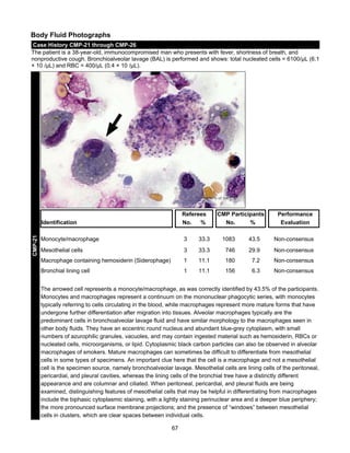 Body Fluid Photographs
Case History CMP-21 through CMP-26
The patient is a 38-year-old, immunocompromised man who presents with fever, shortness of breath, and
nonproductive cough. Bronchioalveolar lavage (BAL) is performed and shows: total nucleated cells = 6100/μL (6.1
× 10 /μL) and RBC = 400/μL (0.4 × 10 /μL).

Referees
No.
%

CMP-21

Identification

CMP Participants
No.
%

Performance
Evaluation

Monocyte/macrophage

3

33.3

1083

43.5

Non-consensus

Mesothelial cells

3

33.3

746

29.9

Non-consensus

Macrophage containing hemosiderin (Siderophage)

1

11.1

180

7.2

Non-consensus

Bronchial lining cell

1

11.1

156

6.3

Non-consensus

The arrowed cell represents a monocyte/macrophage, as was correctly identified by 43.5% of the participants.
Monocytes and macrophages represent a continuum on the mononuclear phagocytic series, with monocytes
typically referring to cells circulating in the blood, while macrophages represent more mature forms that have
undergone further differentiation after migration into tissues. Alveolar macrophages typically are the
predominant cells in bronchoalveolar lavage fluid and have similar morphology to the macrophages seen in
other body fluids. They have an eccentric round nucleus and abundant blue-grey cytoplasm, with small
numbers of azurophilic granules, vacuoles, and may contain ingested material such as hemosiderin, RBCs or
nucleated cells, microorganisms, or lipid. Cytoplasmic black carbon particles can also be observed in alveolar
macrophages of smokers. Mature macrophages can sometimes be difficult to differentiate from mesothelial
cells in some types of specimens. An important clue here that the cell is a macrophage and not a mesothelial
cell is the specimen source, namely bronchoalveolar lavage. Mesothelial cells are lining cells of the peritoneal,
pericardial, and pleural cavities, whereas the lining cells of the bronchial tree have a distinctly different
appearance and are columnar and ciliated. When peritoneal, pericardial, and pleural fluids are being
examined, distinguishing features of mesothelial cells that may be helpful in differentiating from macrophages
include the biphasic cytoplasmic staining, with a lightly staining perinuclear area and a deeper blue periphery;
the more pronounced surface membrane projections; and the presence of “windows” between mesothelial
cells in clusters, which are clear spaces between individual cells.
67

 